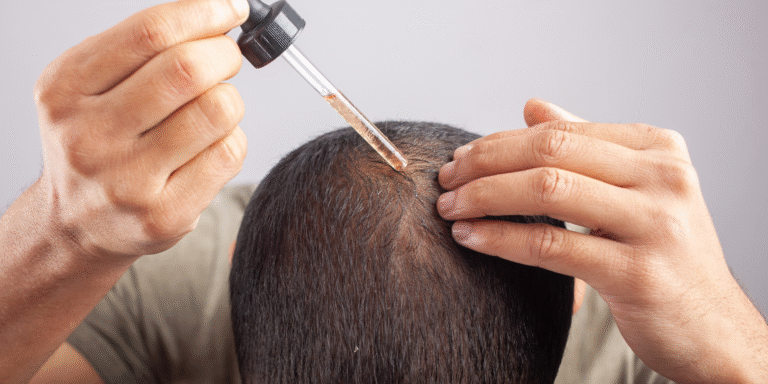 Minoxidil ou Finasterida qual a melhor